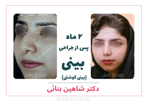 تصویر قبل و بعد جراحی زیبایی بینی دکتر بنایی