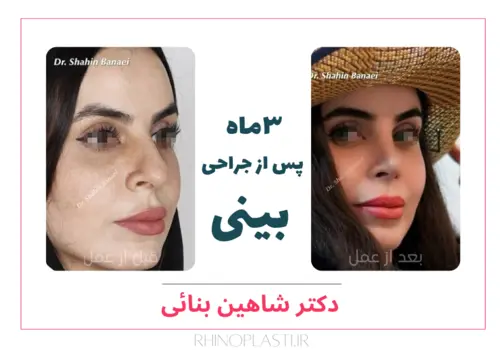 تصویر قبل و بعد جراحی زیبایی بینی دکتر بنایی